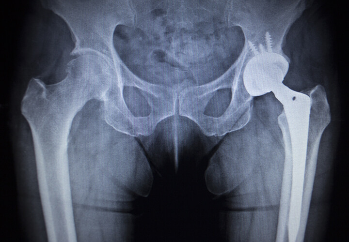 x-ray of hip fracture